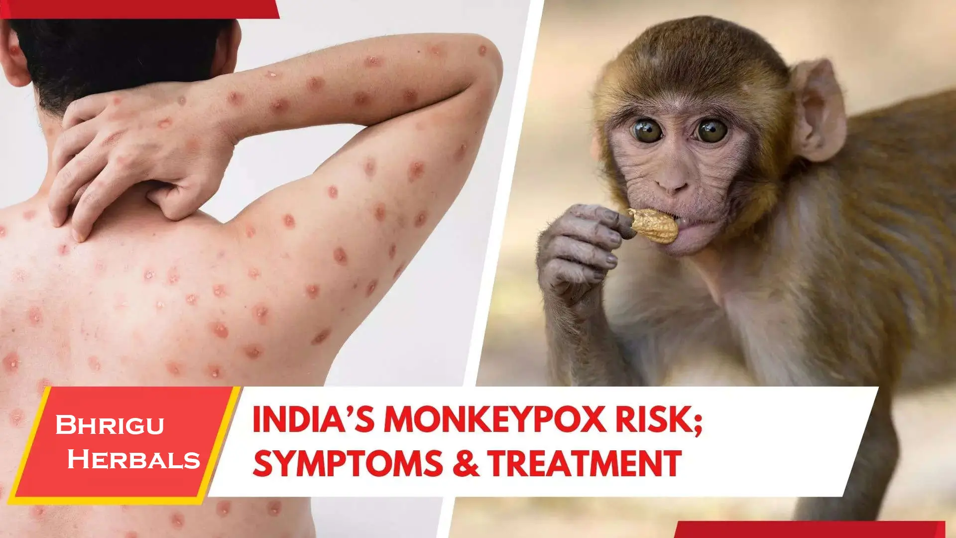 India Monkey Pox risk